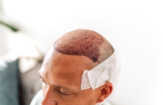 The Art and Science of Hairline Design in Hair Transplantation: